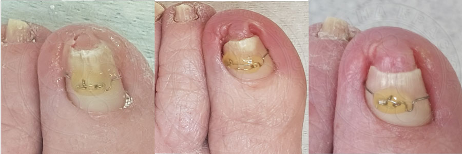 лечение запущенного грибка ногтей