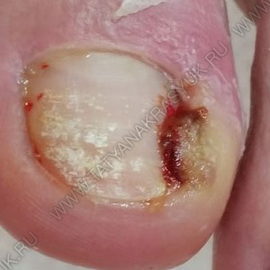 лечение вросшего ногтя с воспалением и образованием грануляций